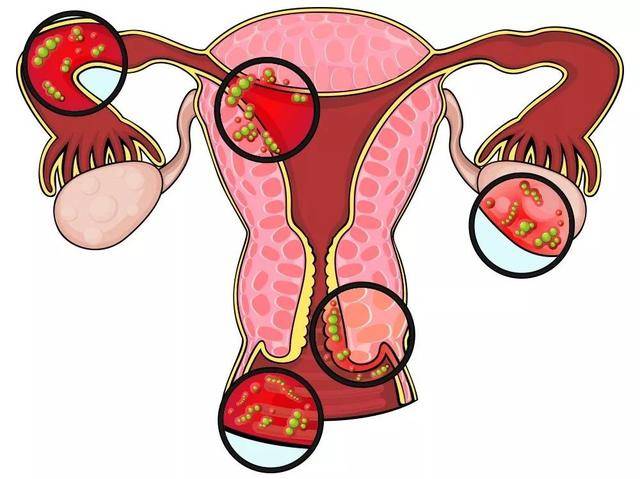 外阴炎尤其是外阴白斑可能会引起癌症,阴道炎可能会引起暂时性不孕