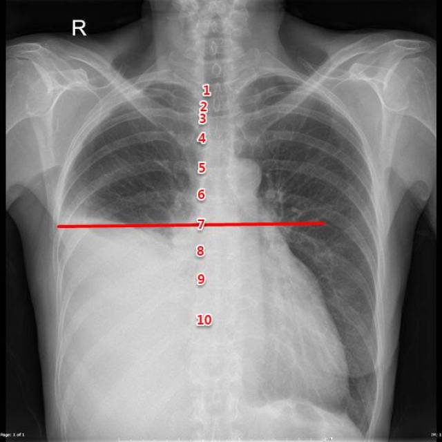 胸片,ct,b超如何定位胸水?这11张图告诉你!-健康频道