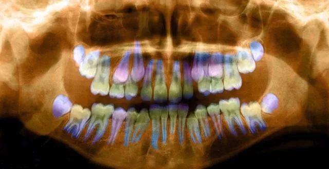 这种片子可以看出所有牙齿的形态,位置,包括颌骨内的情况,比如能看出
