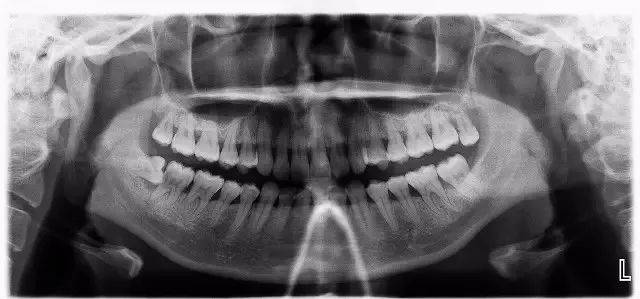 智齿口腔全景片