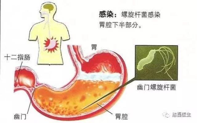 nejm研究确认根除幽门螺杆菌能预防异时性胃癌