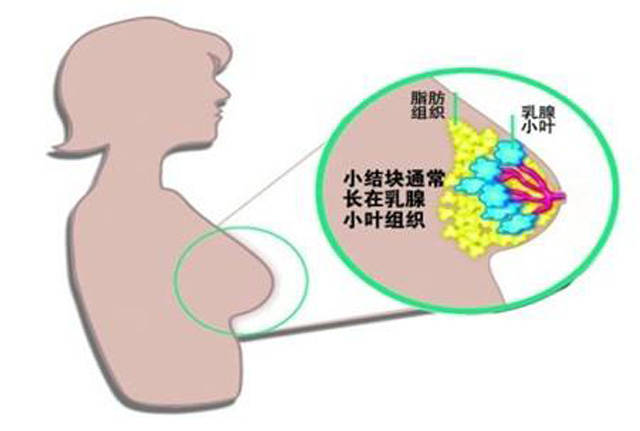 作案方式:趁着月经时期,激素的变化导致乳房发生变化,形成乳腺增生