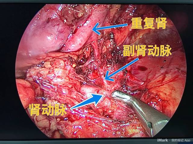 图二 肾动脉发出一条副肾动脉供应重复肾