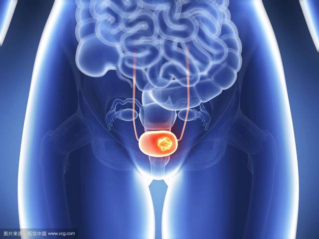 肿瘤细胞侵犯膀胱三角区,就会刺激到膀胱,也可以及时发现膀胱癌的早期
