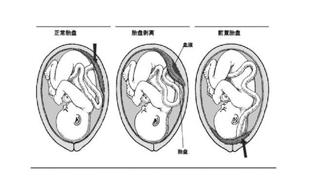 前壁或胎盘后壁,看着这个陌生的词语还真是一脸懵逼,到底是什么意思呢