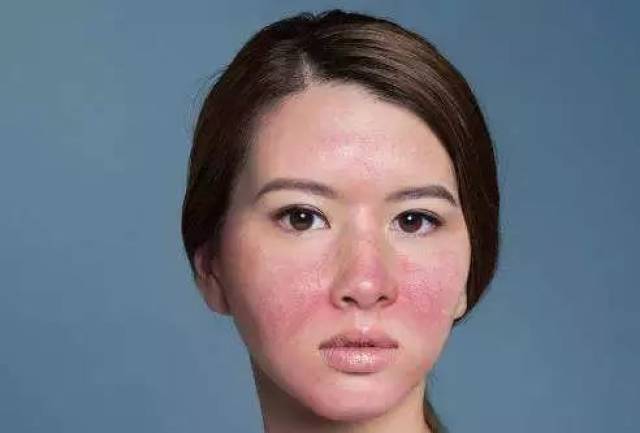 你以为的过敏,可能是玫瑰痤疮!