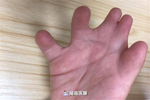 女童五指并连像"鸭掌",奶奶:畸形全赖妈妈,真是这样吗