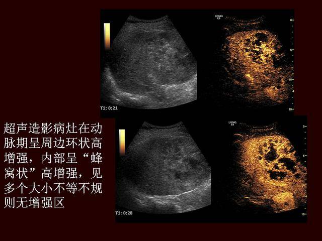 超声造影提高原发性肝癌的诊断灵敏度
