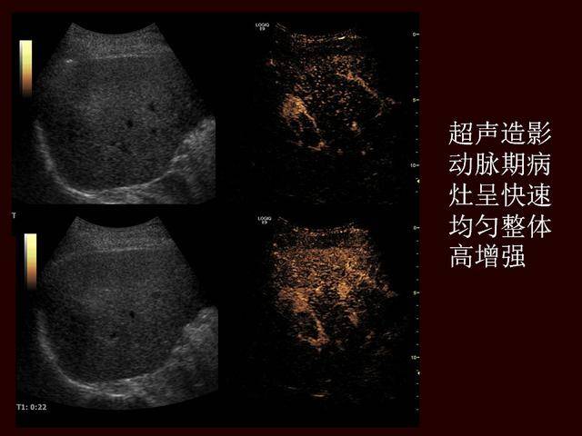 超声造影提高原发性肝癌的诊断灵敏度