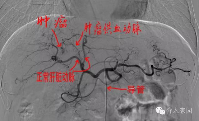 无图不科普,小编就来几张图给大家介绍下tace是如何操作的吧!