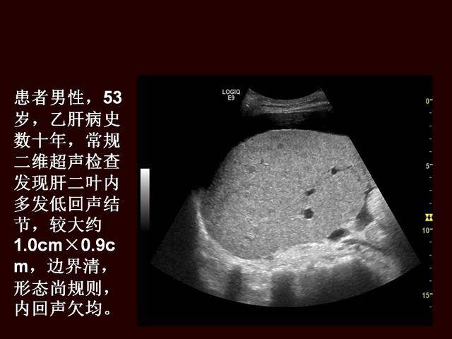 超声造影提高原发性肝癌的诊断灵敏度