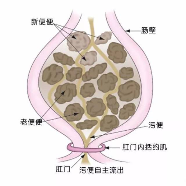 值班大夫看过后,从老人直肠内抠出了大量球状粪便.