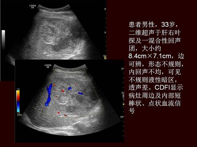 超声造影提高原发性肝癌的诊断灵敏度