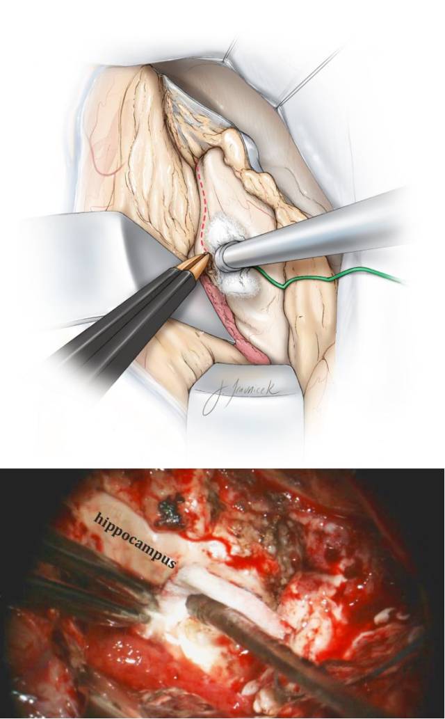 颞叶前内侧切除手术策略与技巧 the neurosurgical atlas全文翻译