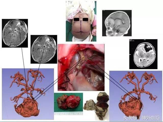 开颅手术显微镜下切除2个月龄婴儿巨大大脑前动脉动脉瘤合并高流量动