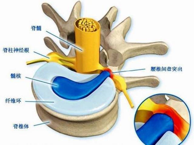 根据纤维环断裂的程度以及髓核露到纤维环外面的程度,"椎间盘突出"的