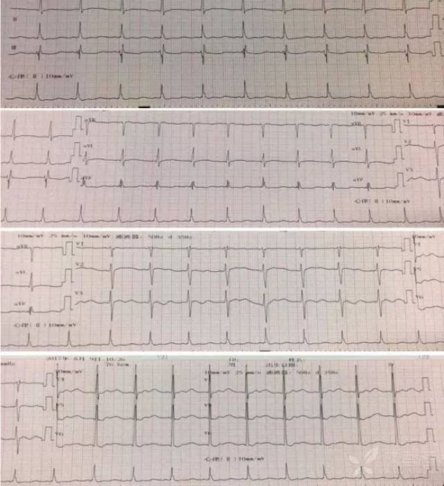 血钾高达 10.22 !看看心电图全程演变与识别处理