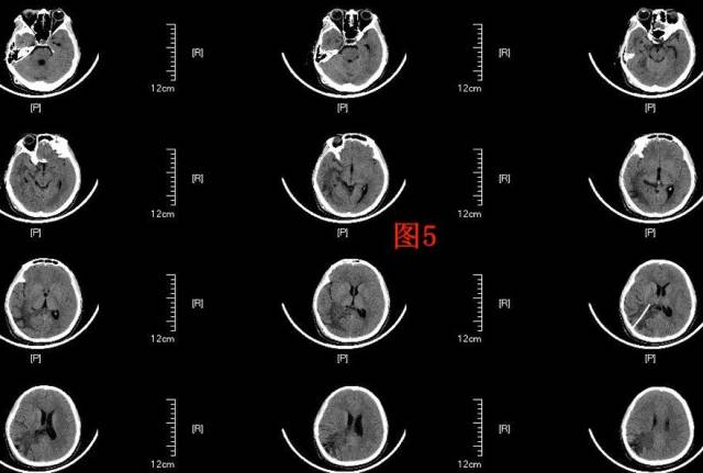 入院后行头部mri(图4)检查提示右侧侧脑室颞角,后角扩张并周围脑组织