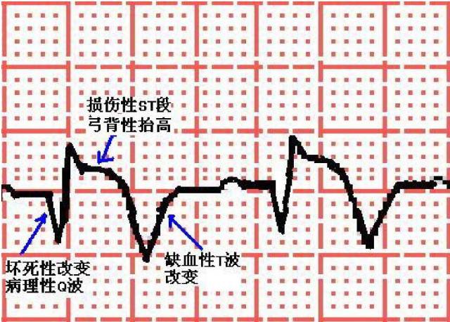 急性心肌梗死心电图特征