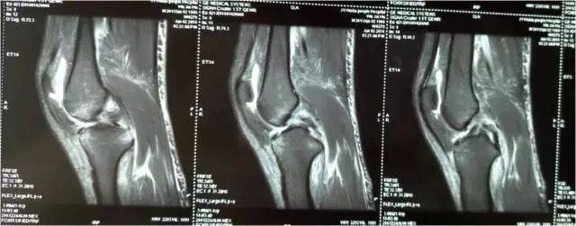 【病例分享】膝关节后交叉韧带损伤术后康复