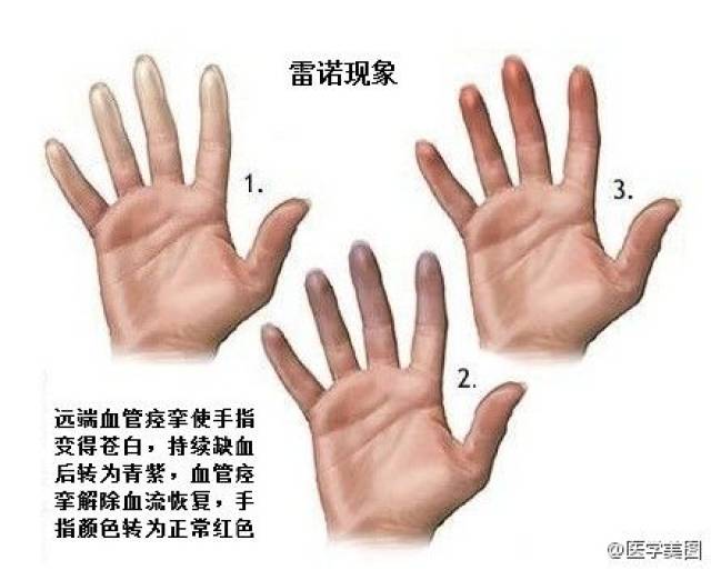 变紫,潮红三色改变,重者可出现局部破溃,坏疽,医学上称之为雷诺现象