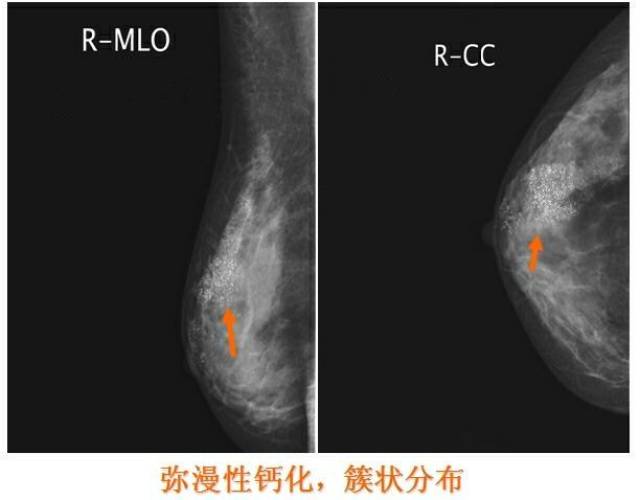 乳腺检查三辆马车——彩超,钼靶,磁共振,该如何选择?