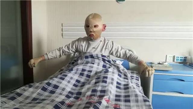 感人!周口一男孩被火烧伤毁容,14岁姐姐希望医生能把脸换给弟弟