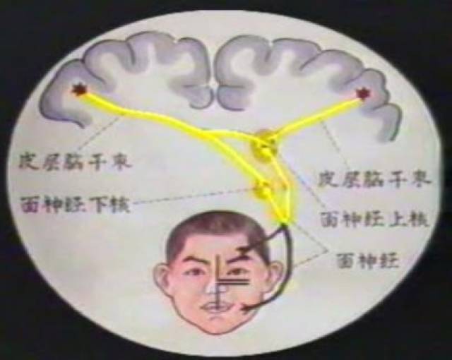 中枢性面神经麻痹-核上性损伤:眼裂以下单侧支配-口角歪斜,额纹不