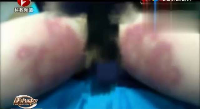 工作室打溶脂针,女孩大腿红肿化脓