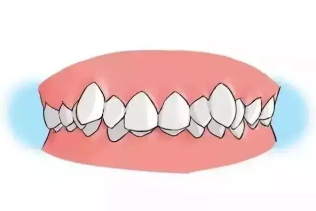 1牙齿排列不整齐 龅牙 2牙齿咬合有障碍 大家通俗上都把牙齿的矫正称