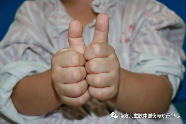 是一种先天性的疾病,又叫弹响指或狭窄性腱鞘炎,"扳机指"