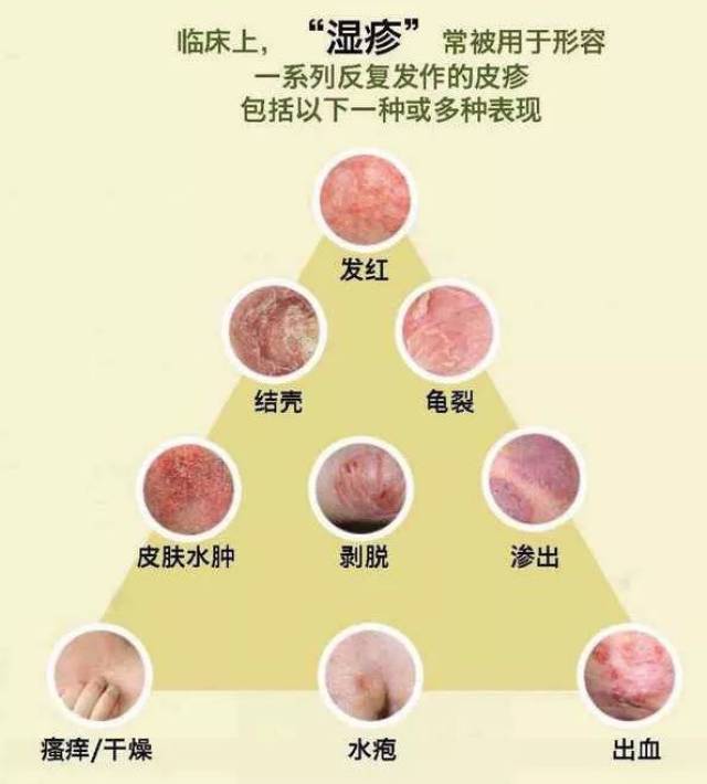 宝宝长湿疹到底要不要抹药膏?