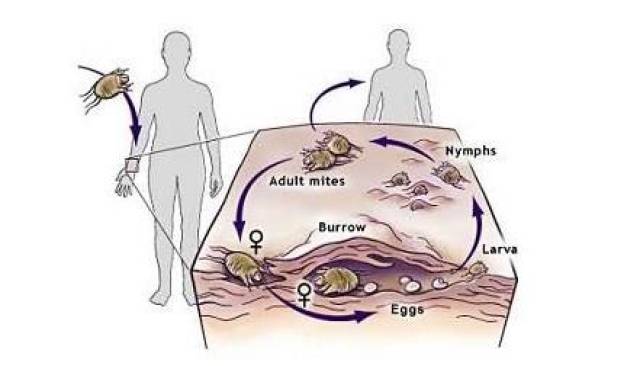 疥疮:一人感染全家遭殃 如何才能灭掉身上的"虫"?