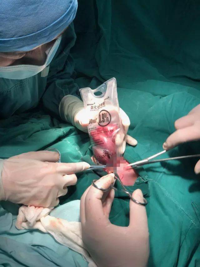 早产儿患腹裂肠子流出 妇产科医院儿科医院接力救治成功