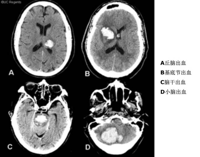 c丘脑穿通动脉-----------丘脑出血  d基底动脉脑桥支---------脑桥
