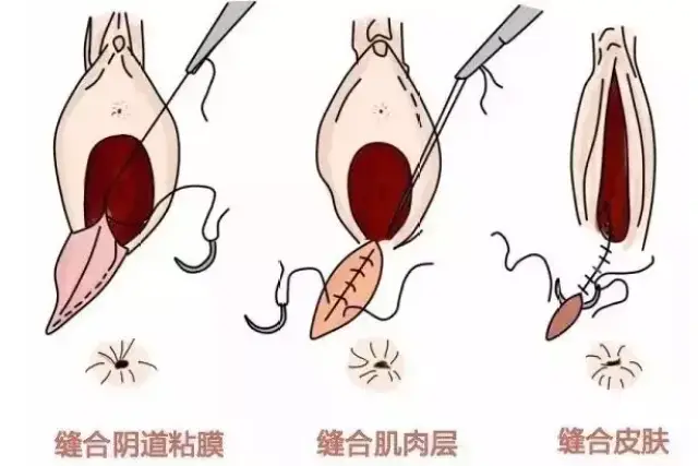 会阴侧切:明明是顺产,为什么还要挨上一刀?