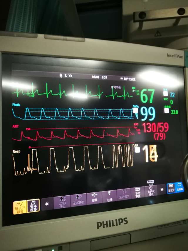 床旁监护仪:icu医护人员的眼睛!