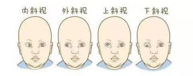 孩子斜视弱视治疗不及时,导致毁一生?专家告诉您真相!