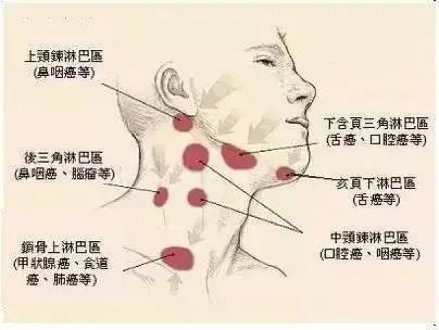 3. 以体表淋巴结肿大为首发表现