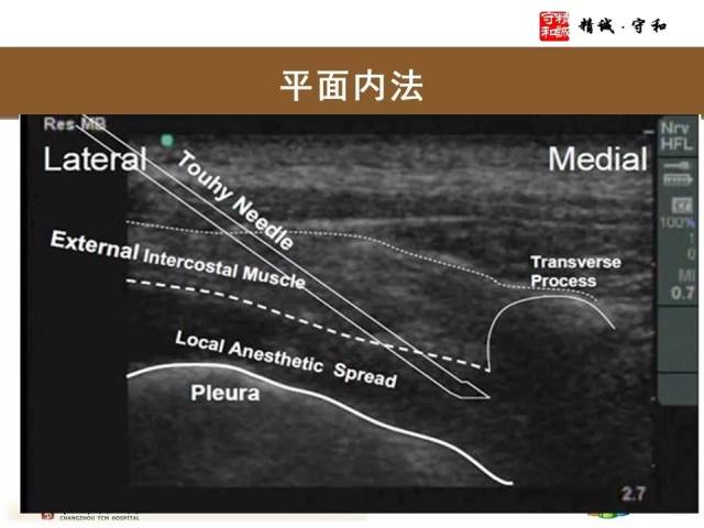 椎旁神经阻滞怎么做?看这里.