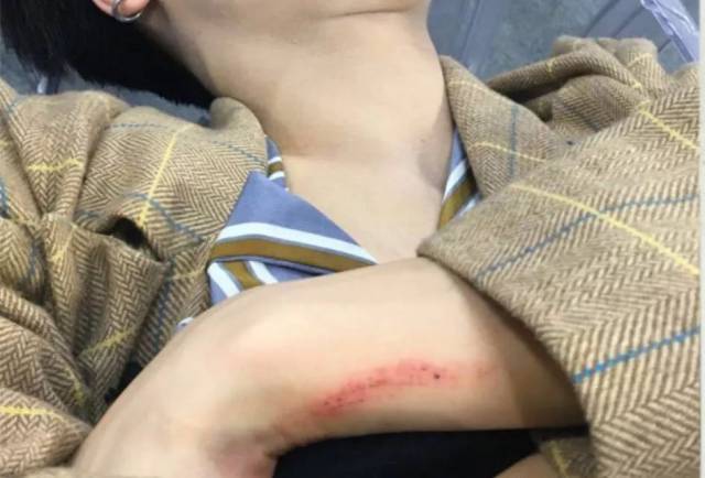 林彦俊手臂受伤坚持彩排