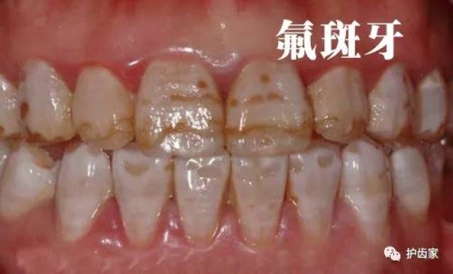 快照照镜子,看看你的牙上有白斑吗?可能是牙齿
