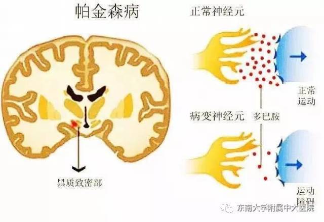 【中大科普】帕金森病离我们并不远,中老年人尤其要小心!