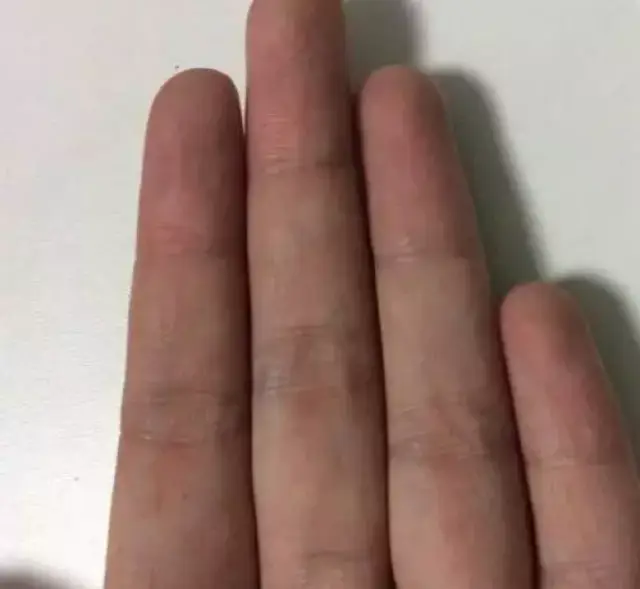 手指上有青筋 可能是你身体出问题了!