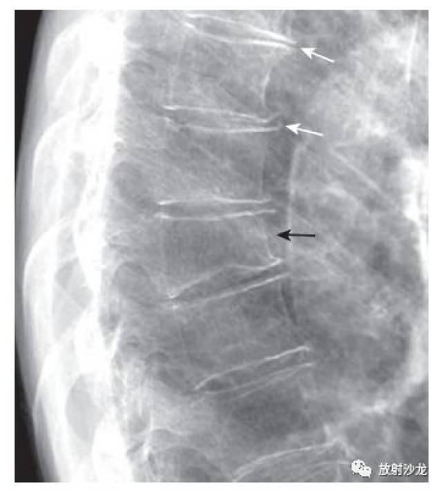 图2-8骨质疏松性压缩性骨折与退行性椎间盘病变.