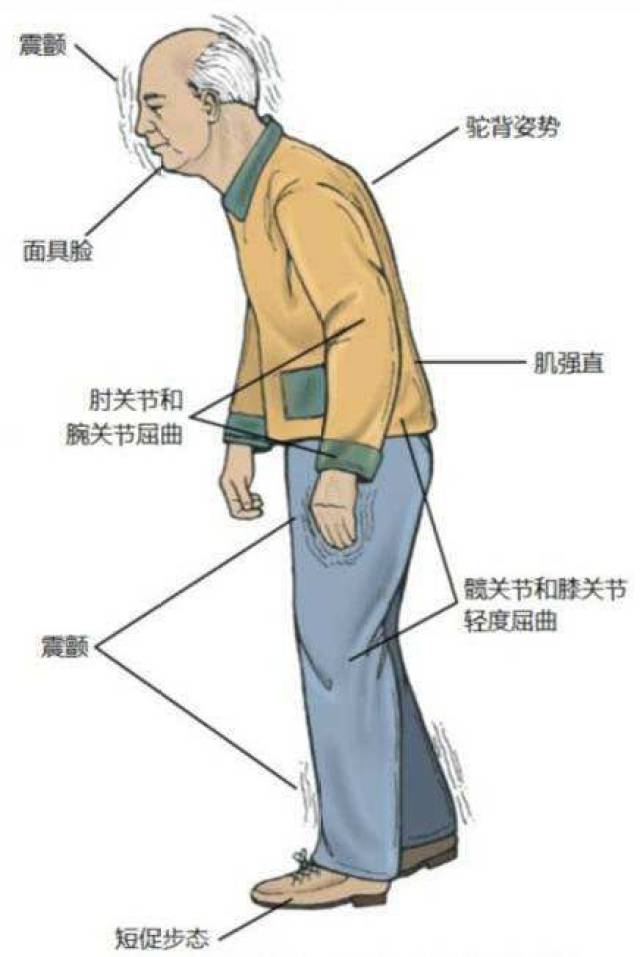 静止性震颤:不自主抖动;拇指和食指呈