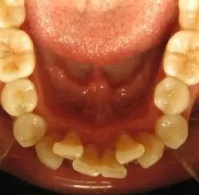 遗传因素 牙列拥挤具有明显的遗传特征,从个别牙的拥挤错位或多数牙