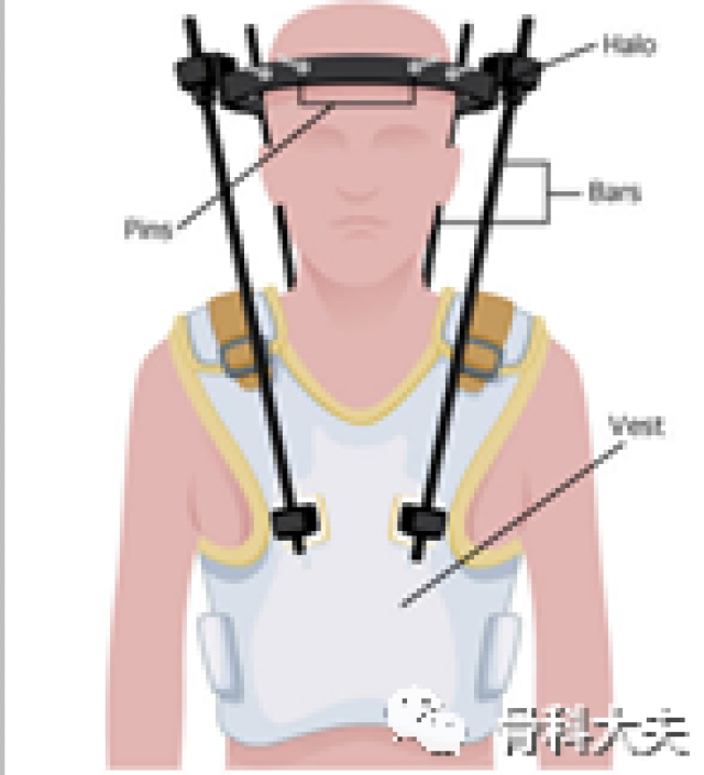 q:还有其他类型的寰枢椎半脱位吗?