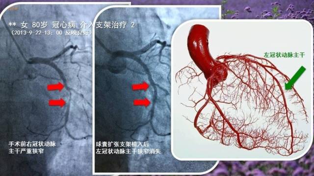 平安保险冠状动脉介入 平安福不包括轻度脑中风