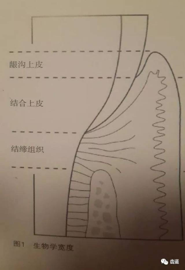 临床上牙龈与修复体边缘的关系